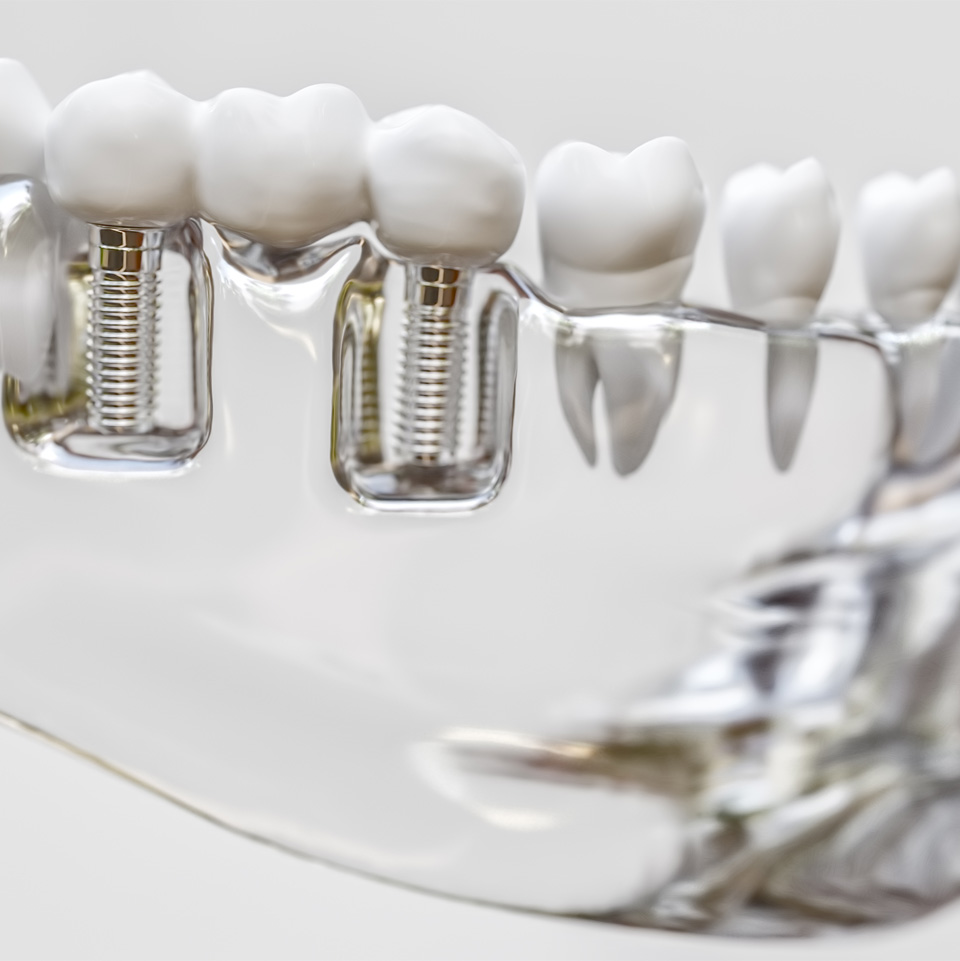 Dental Implants Gerrards Cross