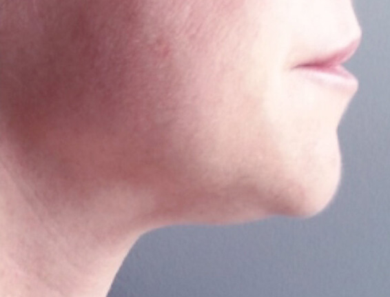 After face fat dissolving injections Buckinghamshire