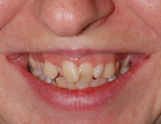 Invisalign straightened teeth before