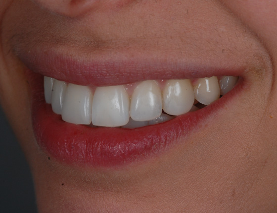 Invisalign teeth straighten after