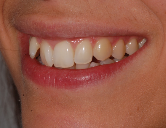 Invisalign teeth straighten before