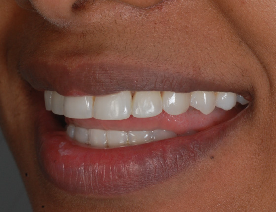 FTS-Invisalign_Straightening-Case5-After