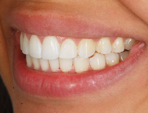 Invisalign straight teeth after