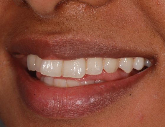 FTS-Invisalign_Straightening-Case5-Before