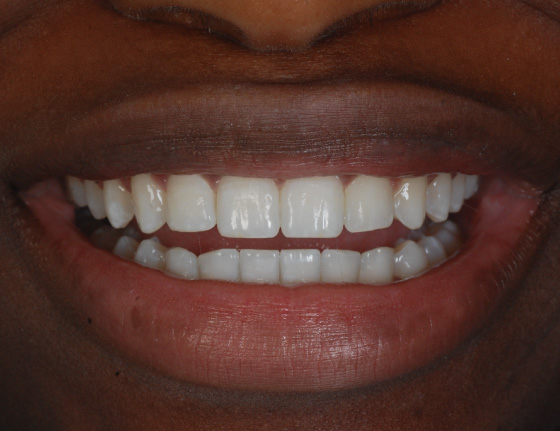 FTS-Invisalign_Straightening-Case6-After