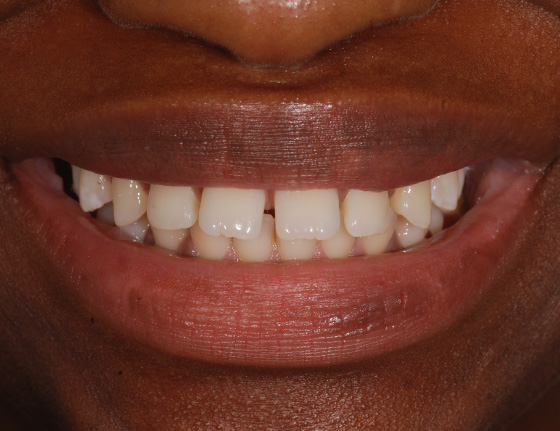 FTS-Invisalign_Straightening-Case6-Before