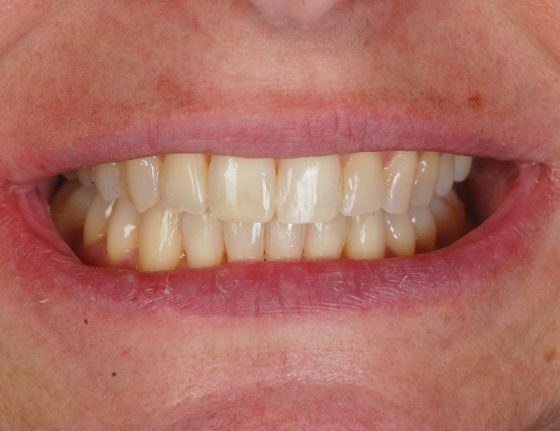 FTS-Invisalign_Straightening-Case7-After