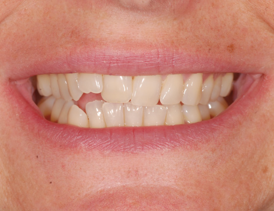 FTS-Invisalign_Straightening-Case7-Before