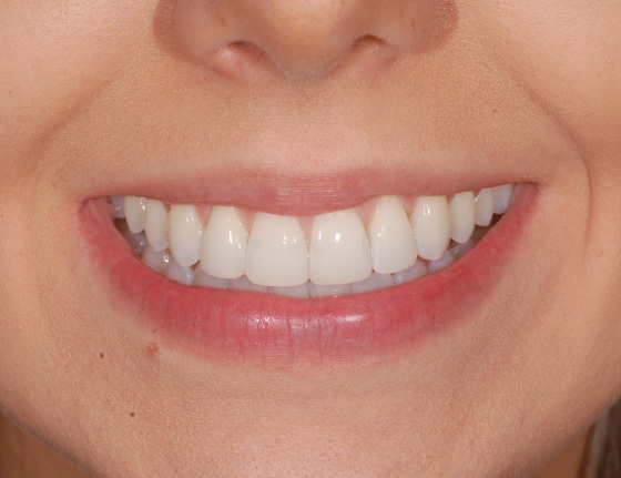 FTS-Invisalign_Straightening-Case8-After