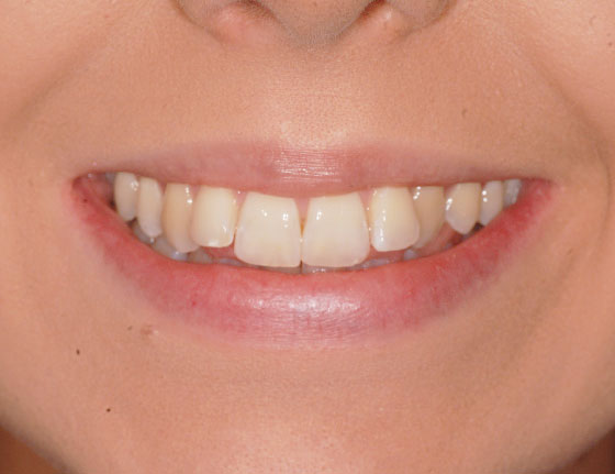 FTS-Invisalign_Straightening-Case8-Before