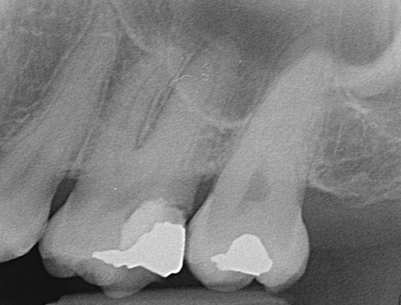 After endodontic therapy