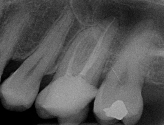 Before endodontic therapy