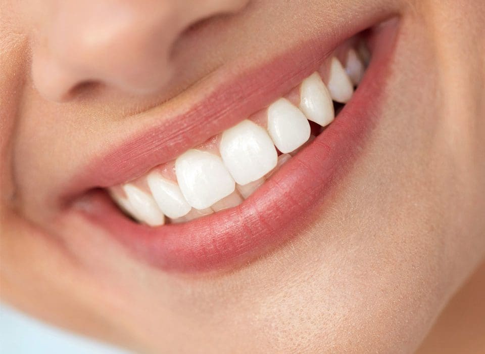 Teeth Whitening Buckinghamshire