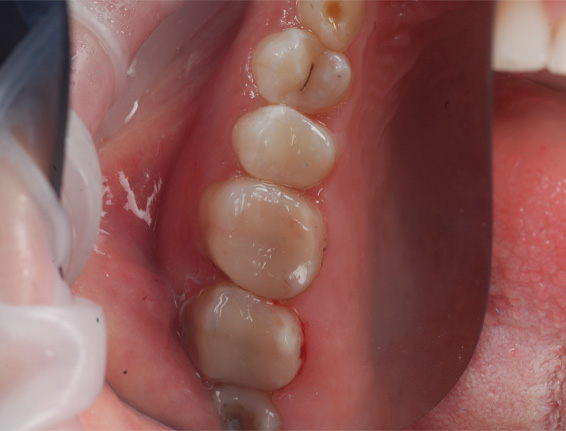 FTS-White_Fillings-Case4-After