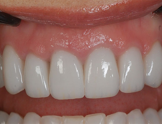 After gum reshaping