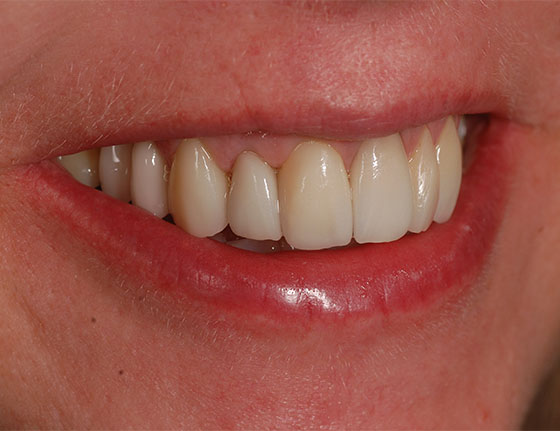 After gum reduction Face Teeth Smile Gerrards Cross