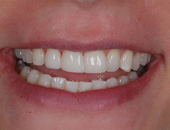 After removing white spots on teeth