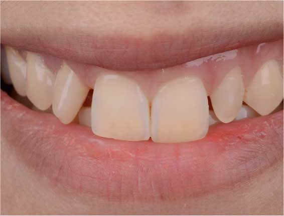 Invisalign teeth straightening before