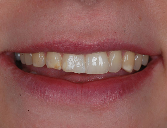 Before removing white spots on teeth