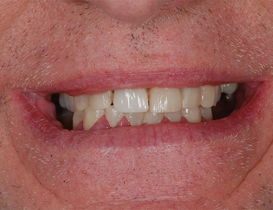 After Dental Implants Buckinghamshire
