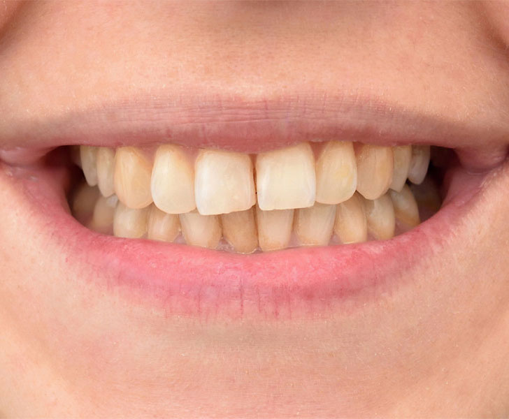https://faceteethsmile.com/wp-content/uploads/2022/02/FTS-Discoloured_Teeth-Section2-1.jpg