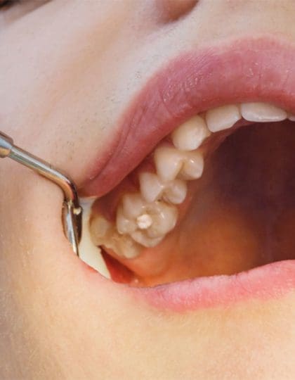 What Happens When You Don’t Brush Your Teeth?