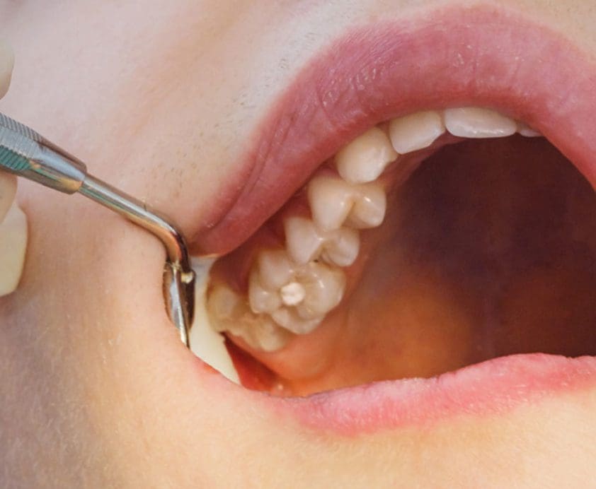 What Happens When You Don’t Brush Your Teeth?