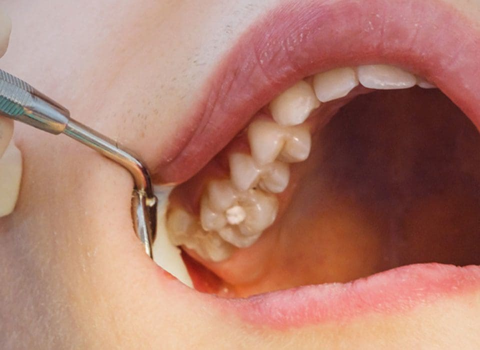 FTS-Lost_Filling-Section1