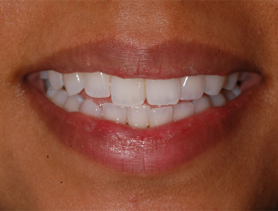 After whitening
