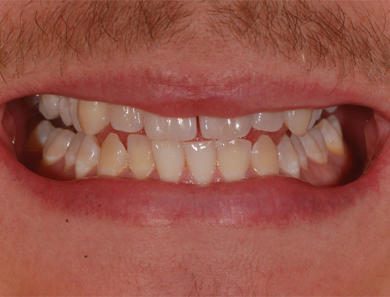 Before tooth whitening
