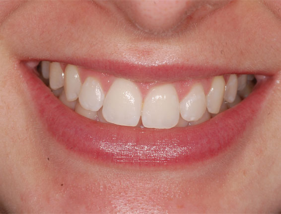 After teeth whitener