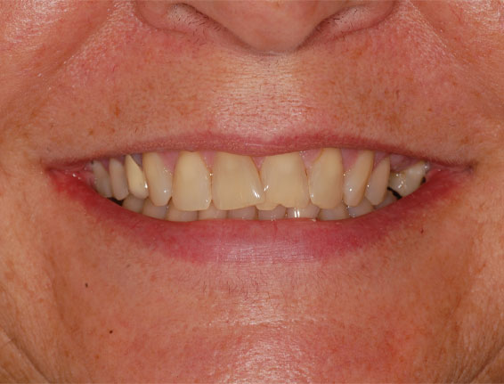 FTS-Teeth_Whitening-Case4-Before