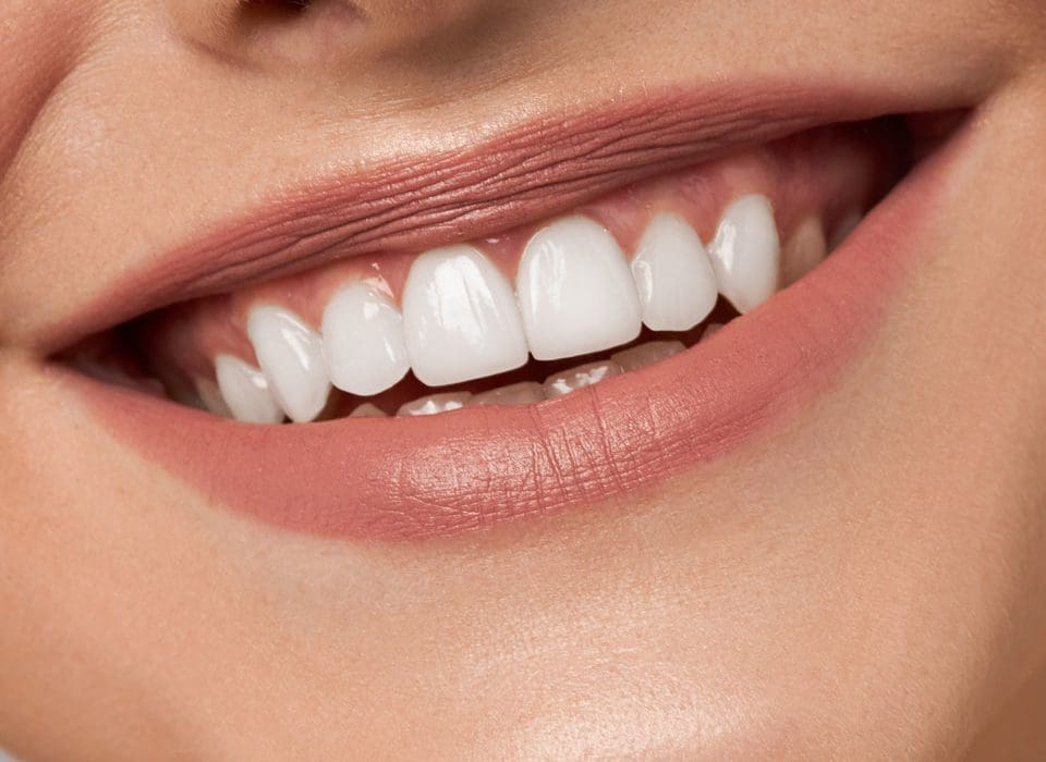 Composite Bonding Buckinghamshire