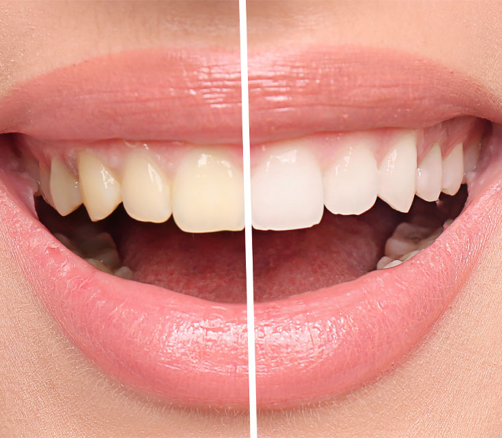 https://faceteethsmile.com/wp-content/uploads/2022/02/FTS-Teeth_Whitening-Second_Image1.jpg