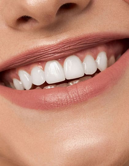 Teeth whitening Chalfont St Peter