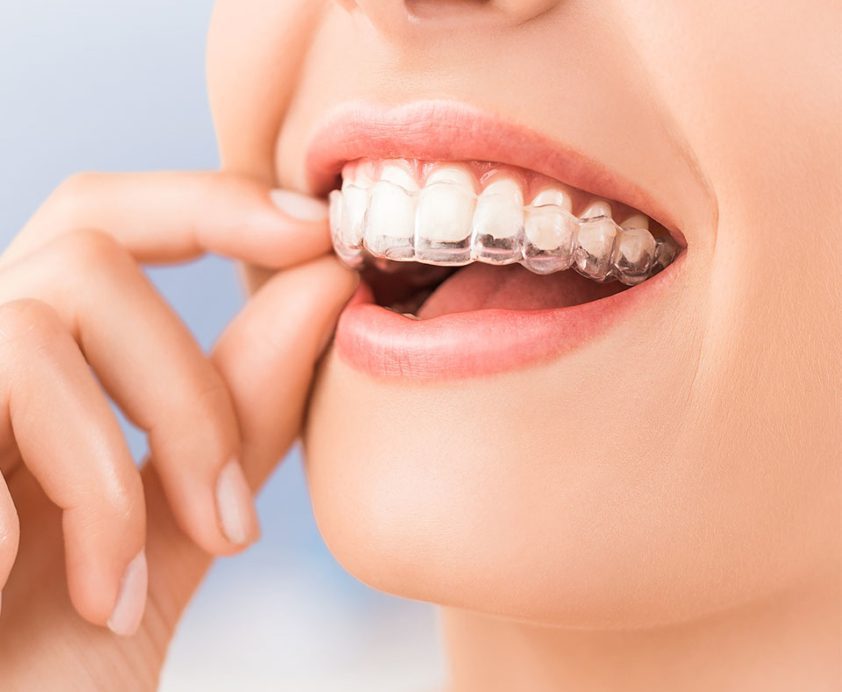 How can Invisalign clear aligners straighten your smile?