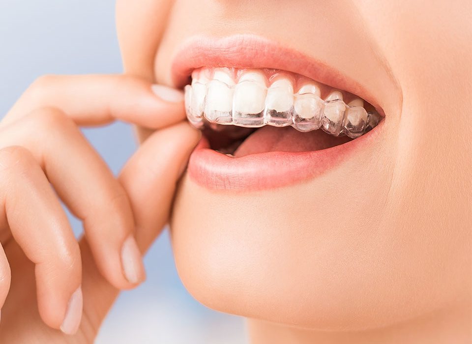 How Can Invisalign Clear Aligners Straighten Your Smile Face Teeth Smile