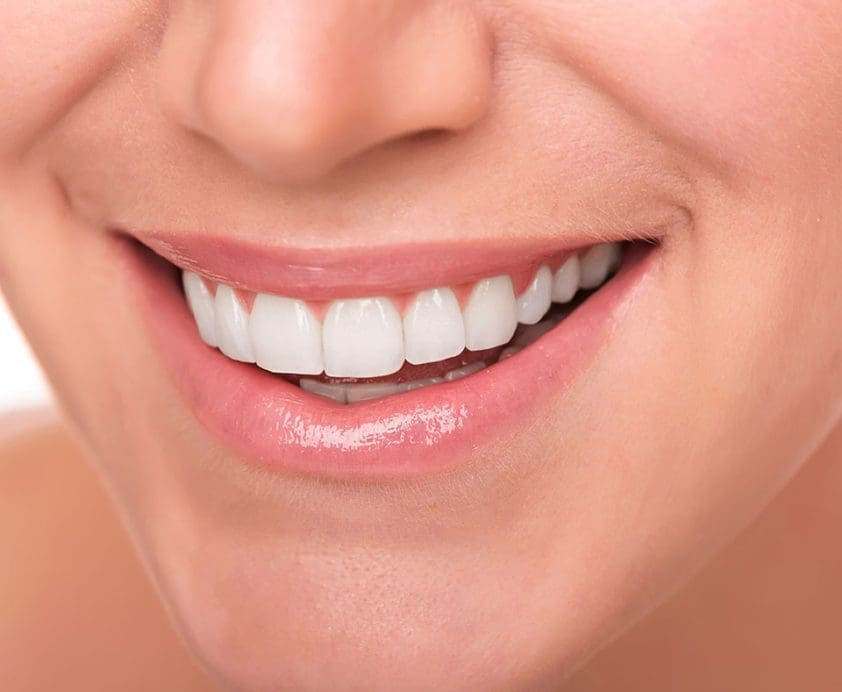 Porcelain veneers vs composite bonding