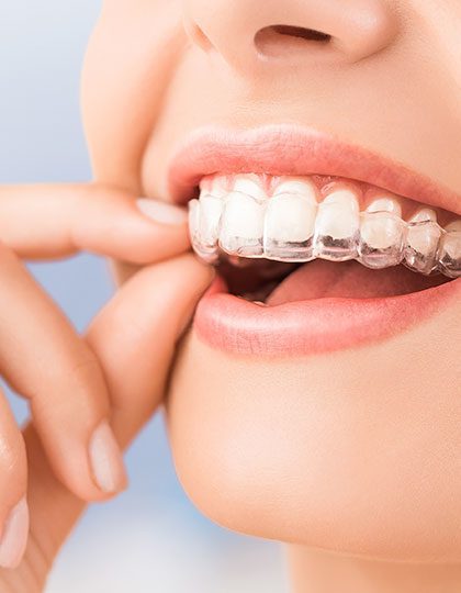Invisalign® Teeth Straightening Package