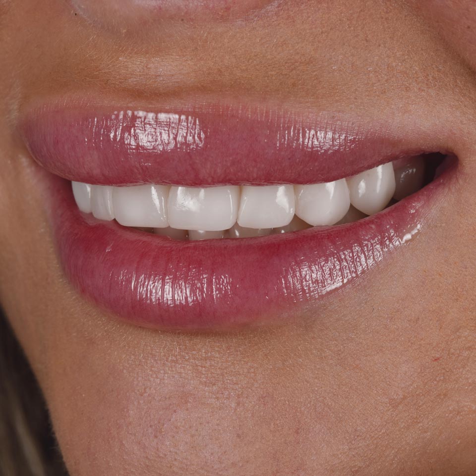 Face Teeth Smile - Milled Composite Veneers