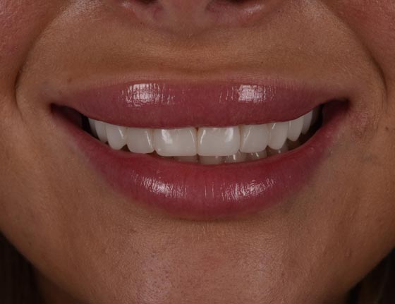 Face Teeth Smile - Milled Composite Veneers Patient After