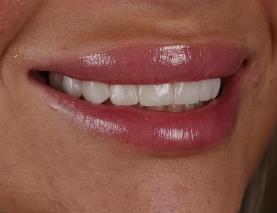 Face Teeth Smile - Milled Composite Veneers Patient After