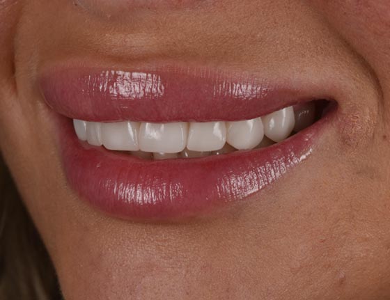 Face Teeth Smile - Milled Composite Veneers Patient After