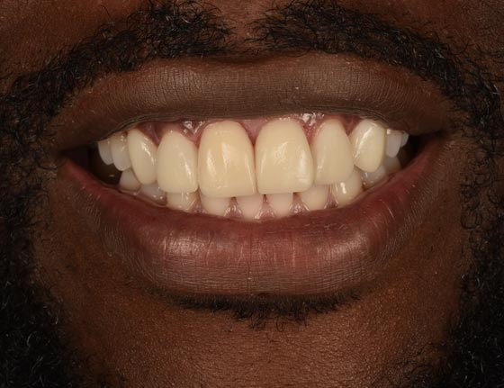 Face Teeth Smile - Milled Composite Veneers Patient After