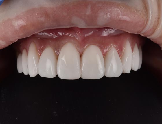 Face Teeth Smile - Milled Composite Veneers Patient After