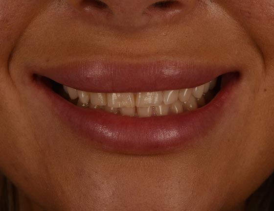 Face Teeth Smile - Milled Composite Veneers Patient Before Image