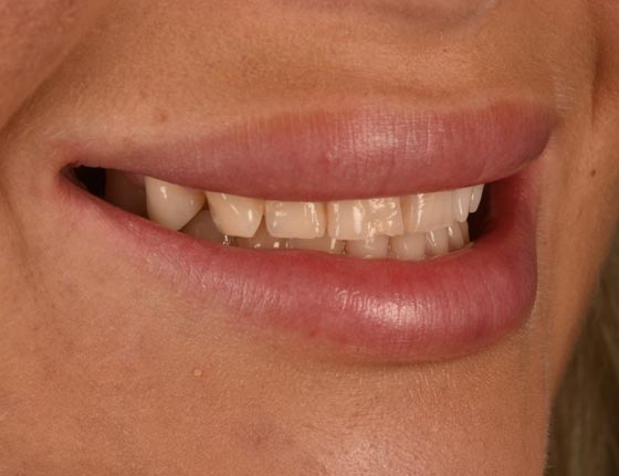 Face Teeth Smile - Milled Composite Veneers Patient Before Image