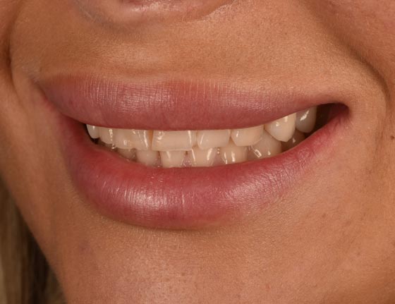 Face Teeth Smile - Milled Composite Veneers Patient Before Image