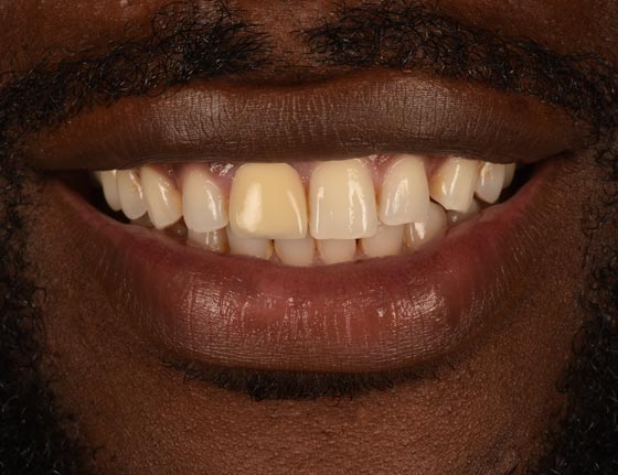 Face Teeth Smile - Milled Composite Veneers Patient Before Image