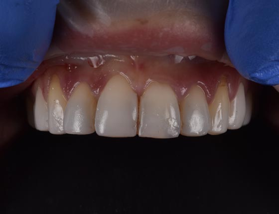 Face Teeth Smile - Milled Composite Veneers Patient Before Image